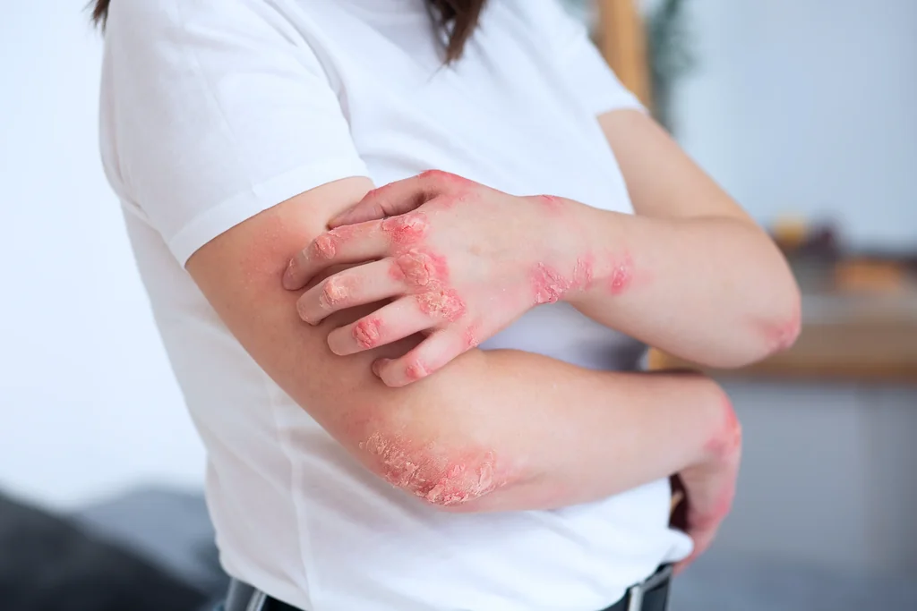 Eczema care at AARx