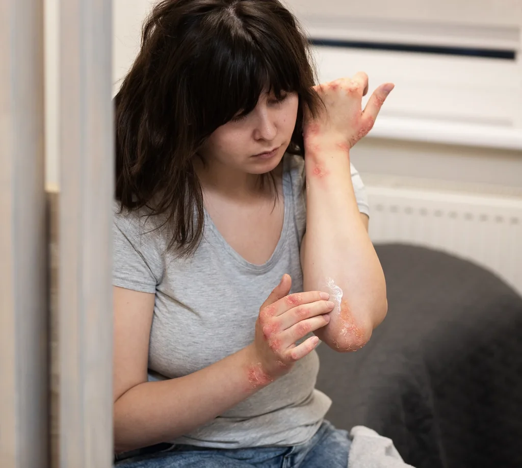 Psoriasis at AARx